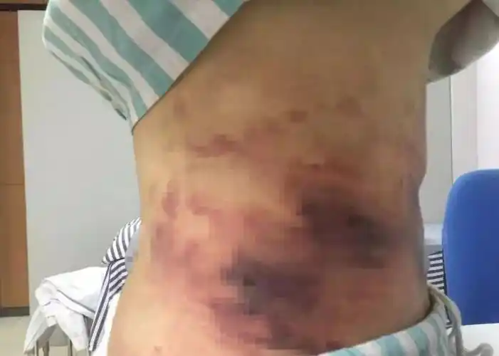 可怕!南宁一女孩为变美做吸脂手术,结果腰部竟出现大片淤黑!
