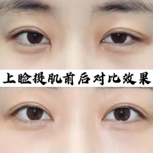 双眼皮割在好看!上睑提肌无力也是白发!