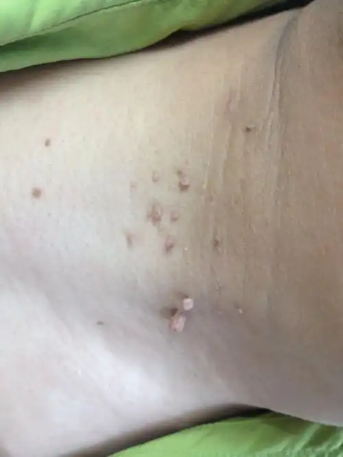 定义小课堂:皮赘仅仅花了几分钟,激光治疗之后,小何(化名)脖子上的小