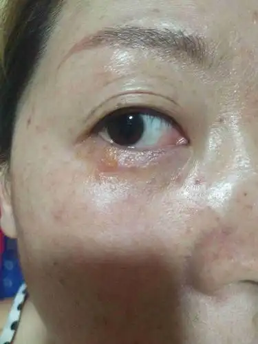 这个下眼睑长了什么东西?