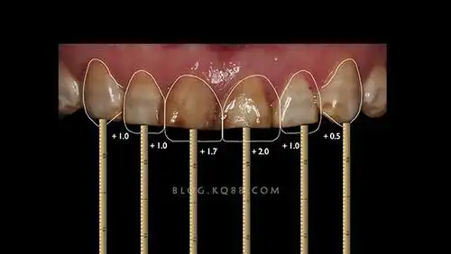 患者喜好确定牙齿外形确定其他前牙位置及长宽比重新定义中切牙宽长比