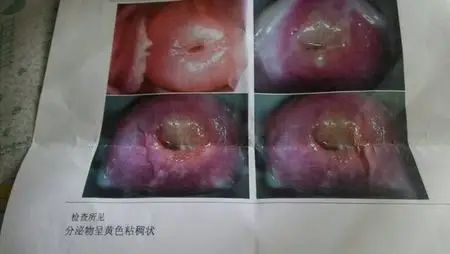 是不是宫颈炎?