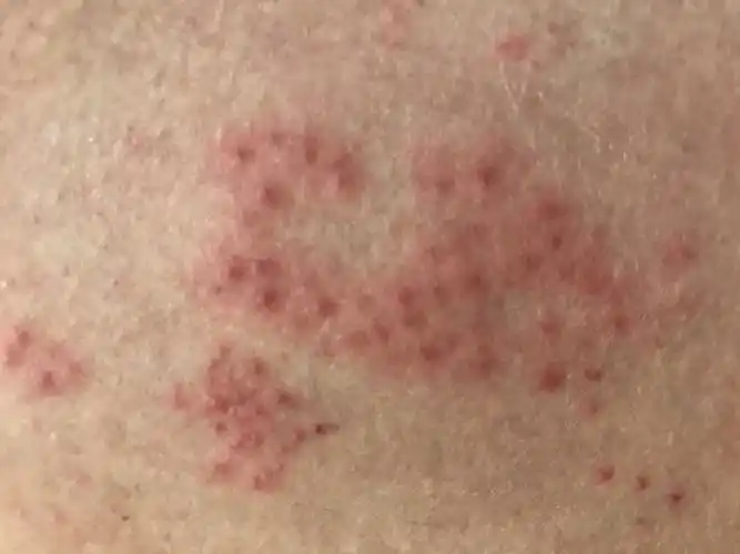 2月2号晚上我发现大腿内侧有一个巨大的红疹以为是湿疹涂了派