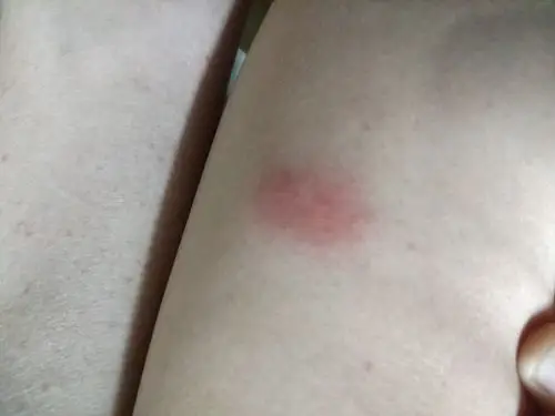 请问这是跳蚤包吗?被咬了好多个,都这么大的包.