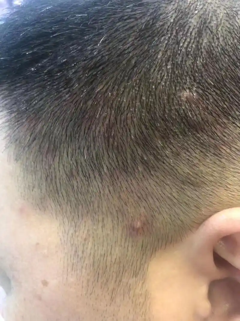 轻度毛囊炎只需用简单洗发水即可,6天基本消失