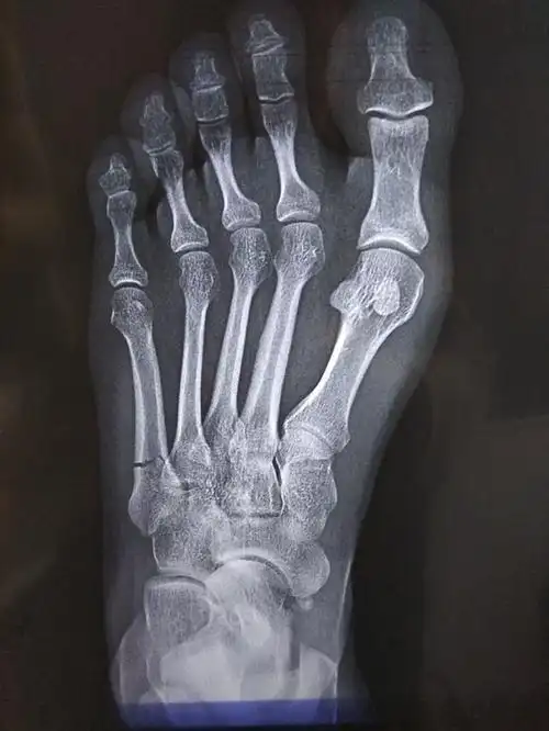 意外险包什么材料 个人意外险