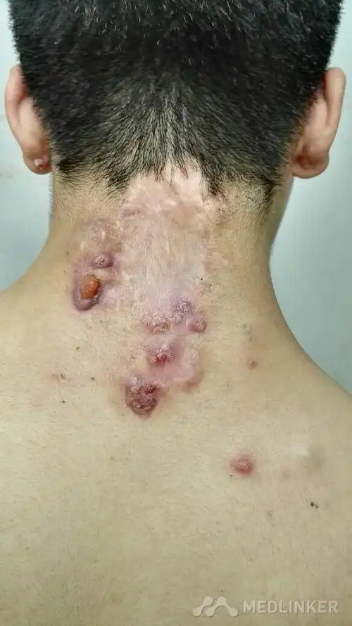 颈部瘢痕疙瘩性毛囊炎