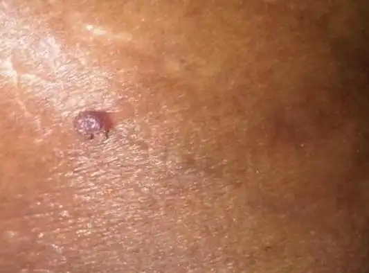 男性尖锐湿疣常发生与生殖器及肛周的部位,具体表现在男性的尿道口