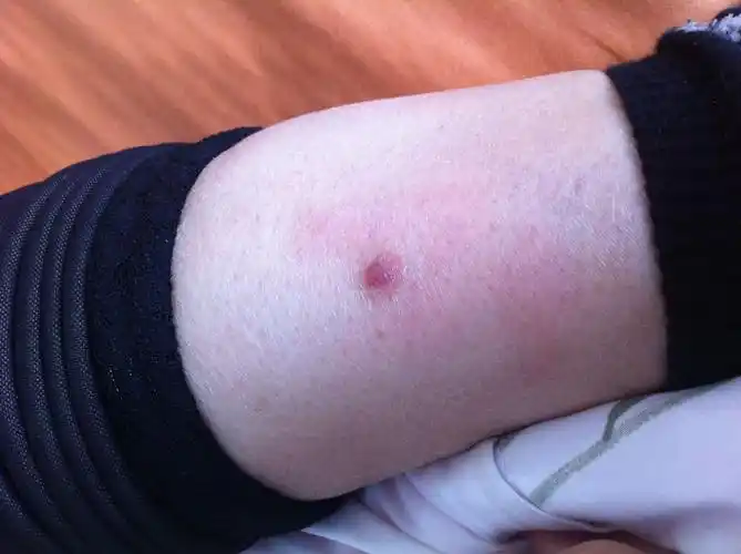 腿上长了这么个东西,里面好像有什么东西,挠破了两次了,都复原了,周围