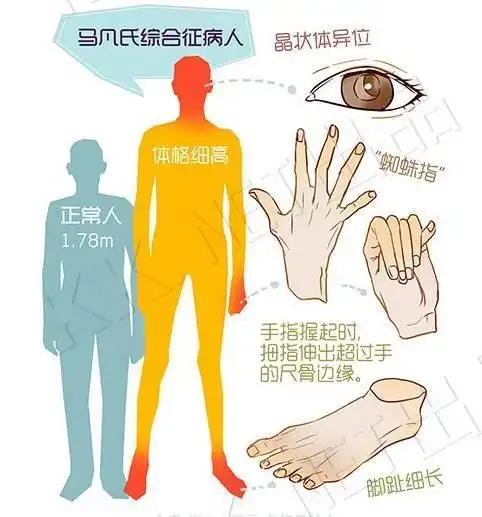 马凡氏综合征患者通常体格异于常人,身高多在1.8米至2.