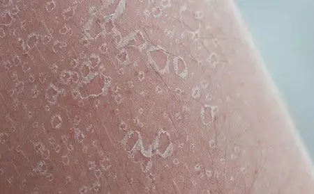 早期牛皮肤癣图片初期症状怎么引起的治疗牛皮肤癣光疗的药膏药物