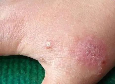 阴囊疥疮怎么治疗,疥疮的治疗方法(疥疮的发病机制,临床表现和治疗)