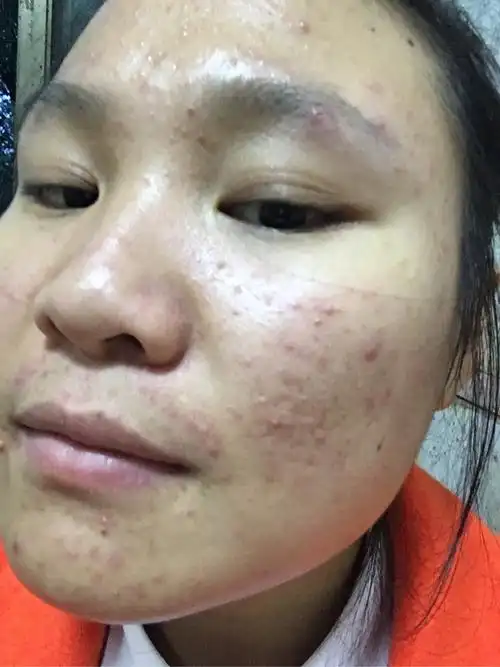 果酸快15天了 - 知乎