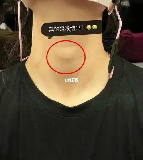 女生长喉结,0101谁能给我解释一下吗?男生?