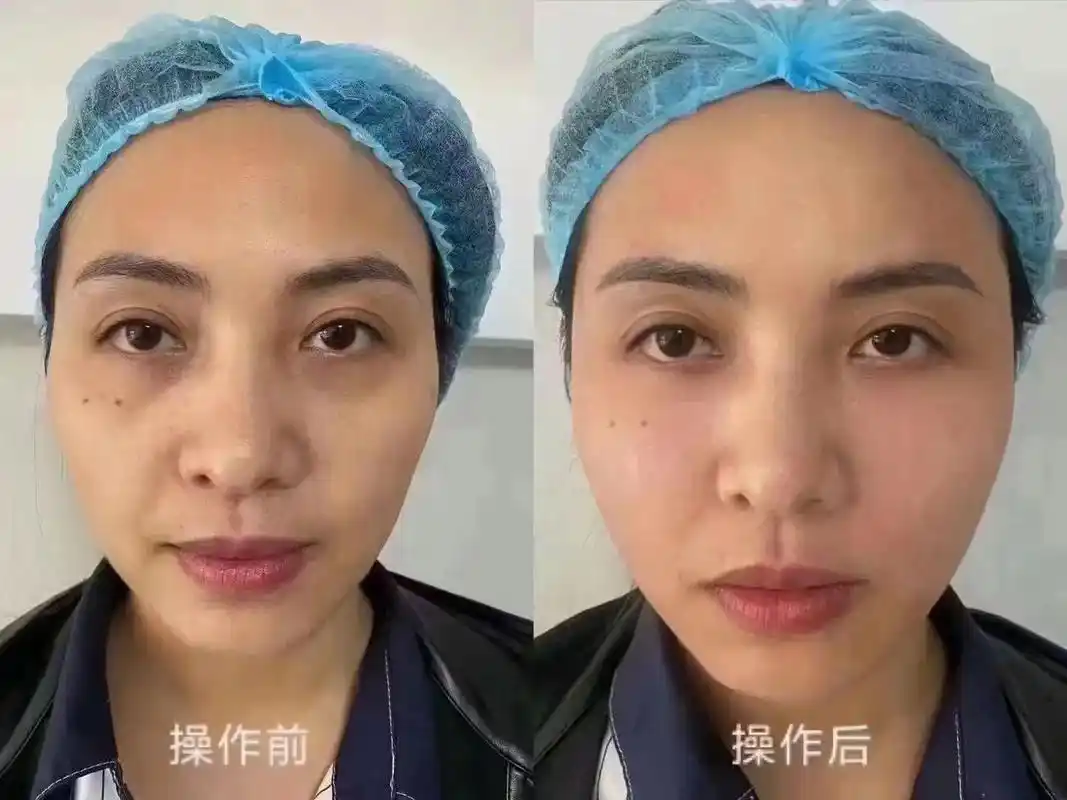 细胞激活,泪沟,太阳穴,面部凹陷填充对比 - 抖音