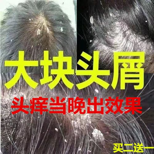 毛囊炎洗发水去屑止痒除螨虫控油去油氨基酸去头皮屑康王头痒洗发