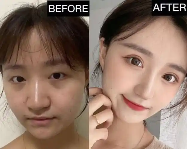 郑州全切双眼皮术后36天反馈