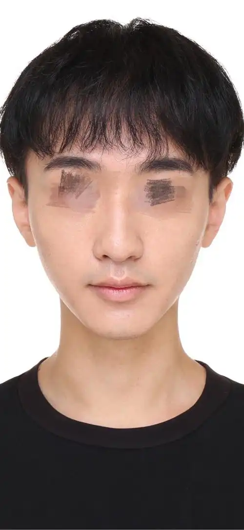 不用担心别人说大鼻头了 焊6张图是没做之前 鼻头大 鼻翼厚 鼻梁驼峰
