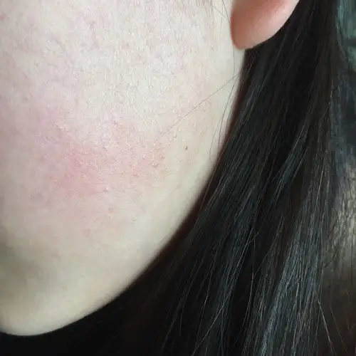 脸上有红血丝 但整体看没有那么严重 仔细看看的清楚一点 夏天 冬天脸