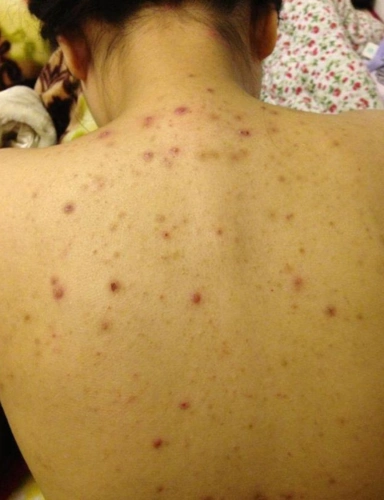 前胸后背的毛囊炎怎么治?林雯老师教你怎么治好得快!_油脂