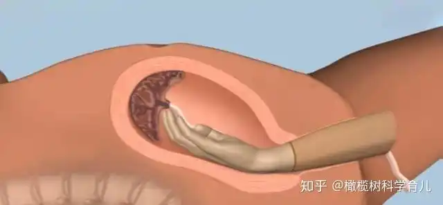 产后有胎盘残留怎么办? - 知乎