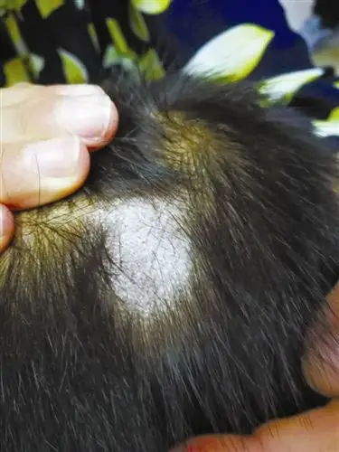 7岁小男孩脱发严重,竟然和ta有关