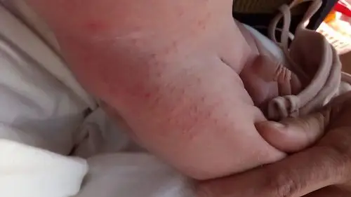 大腿根部长了一片小疙瘩,上网查了一下,是湿疹.