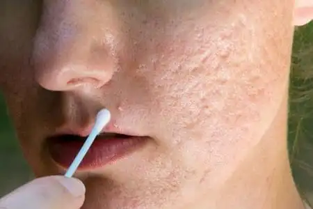 四个方法改善面部皮肤毛孔粗大-女性资讯网