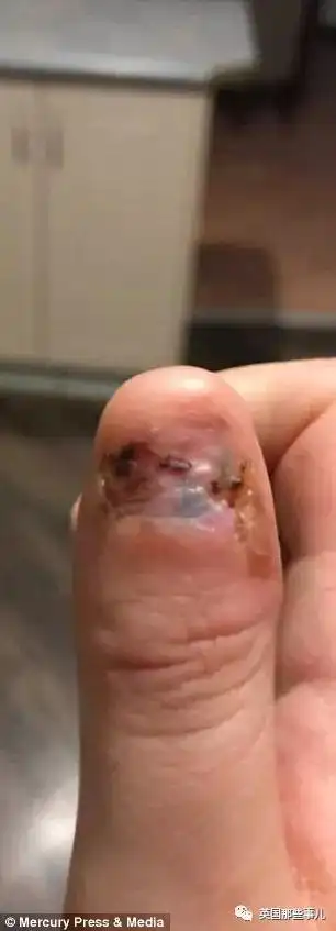 20岁姑娘一紧张就喜欢咬指甲,可……竟然咬到需要截肢