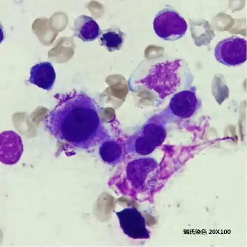 骨髓异常增生综合征合并巨幼细胞性贫血1例