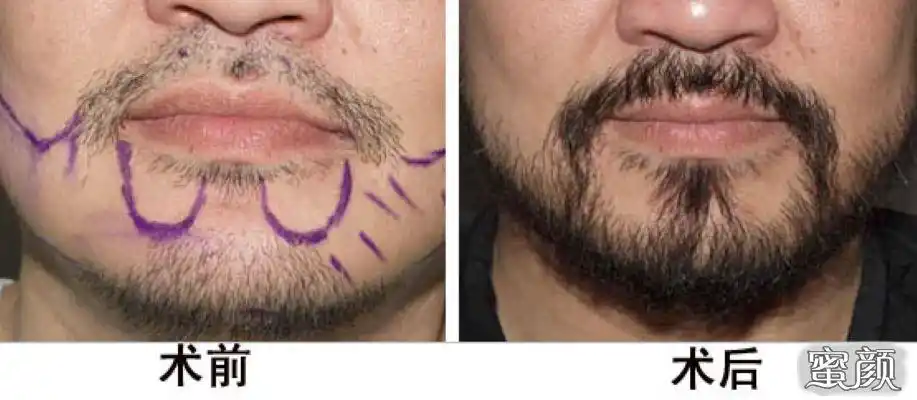 种植胡须的效果图怎么样呢?进来看看吧!