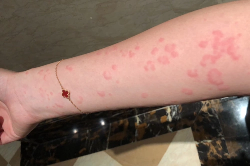 脖子|医生|提醒|风团|寒冷性荨麻疹|孙先生|皮肤|患者|-健康界