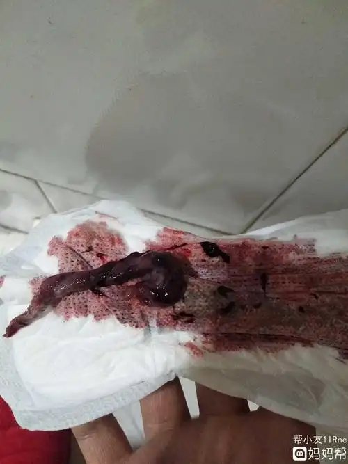 引起消化道大出血的疾病 流产大出血属于疾病险