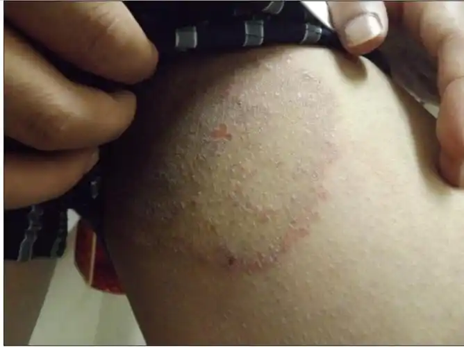 我的大腿根下,睾丸两侧长了很多小红疙瘩,后来成了片状,这是什么病,能