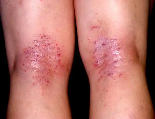 女性皮炎_有来医生