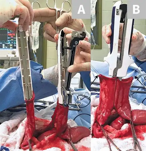 胃肠吻合术使用线型吻合器的六大步骤|手术|张力|空肠_网易订阅