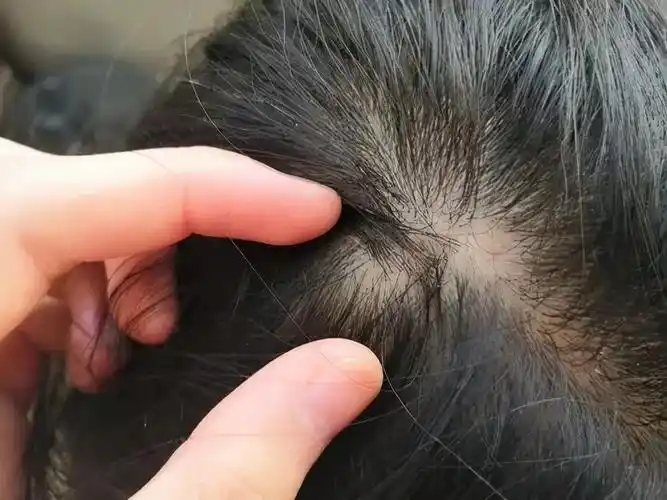 这种情况下头皮油脂分泌过多,毛囊受到损伤,从而发展为炎症性丘疹