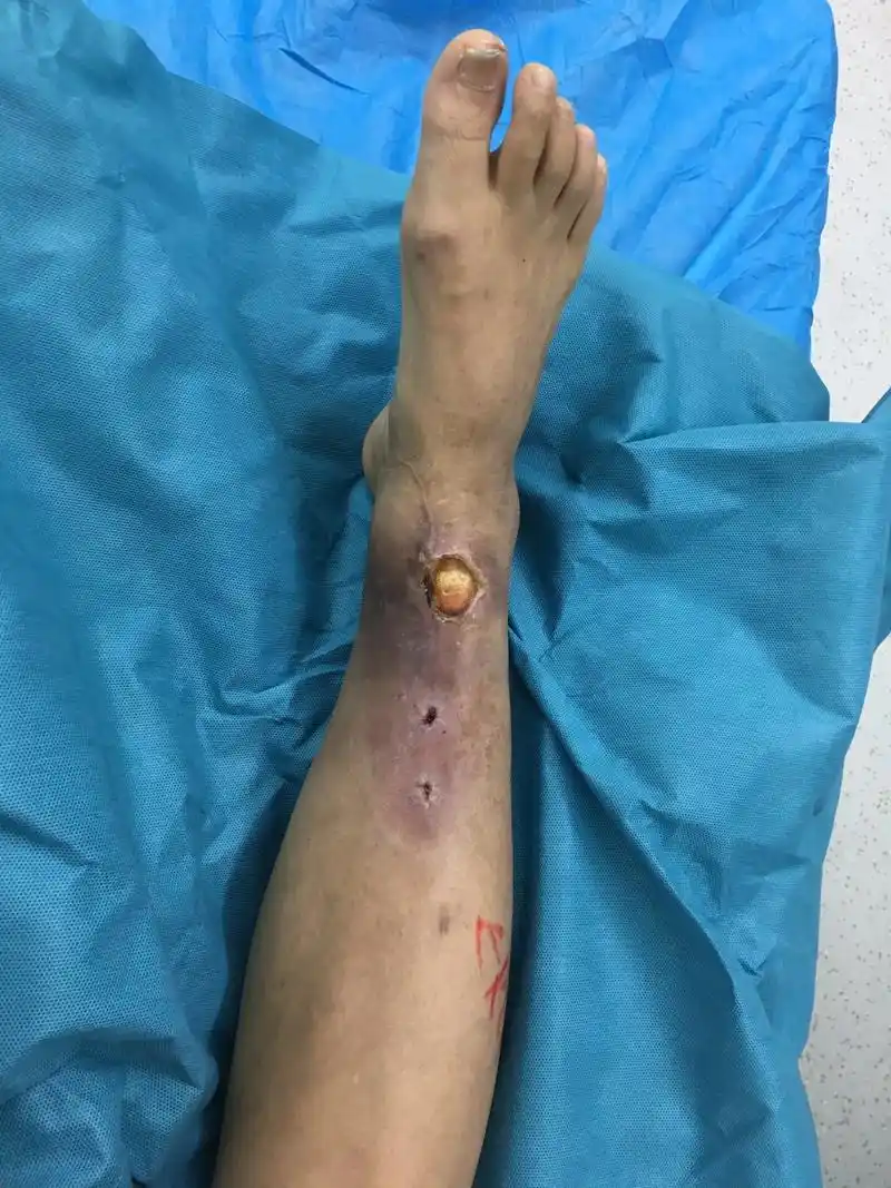 皮肤缺损不愈合一年余.骨折内固定术后皮肤坏死,肌腱外露,伤口 - 抖音