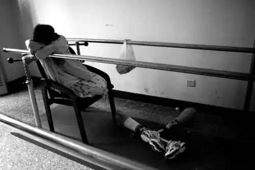 5·12汶川地震中受伤,双大腿高位截肢