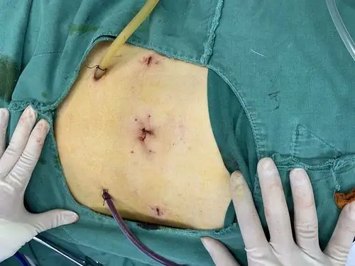 直肠癌nose术后腹部切口照片