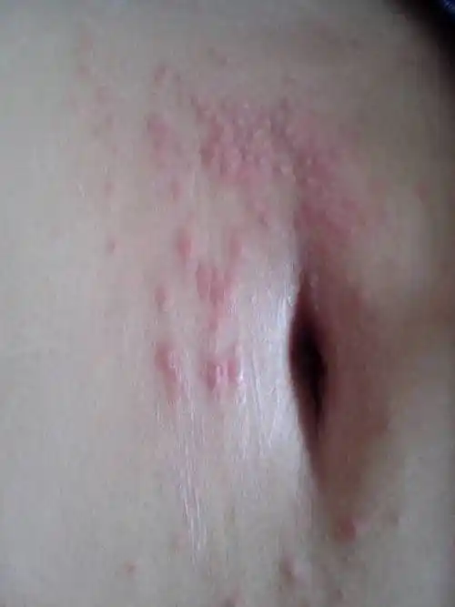 皮肤对铁过敏,小肚子上有好多小红疙瘩,又痒又痛怎么办啊