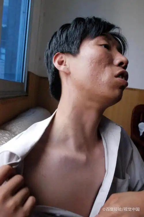 颈部金三角怎么保养