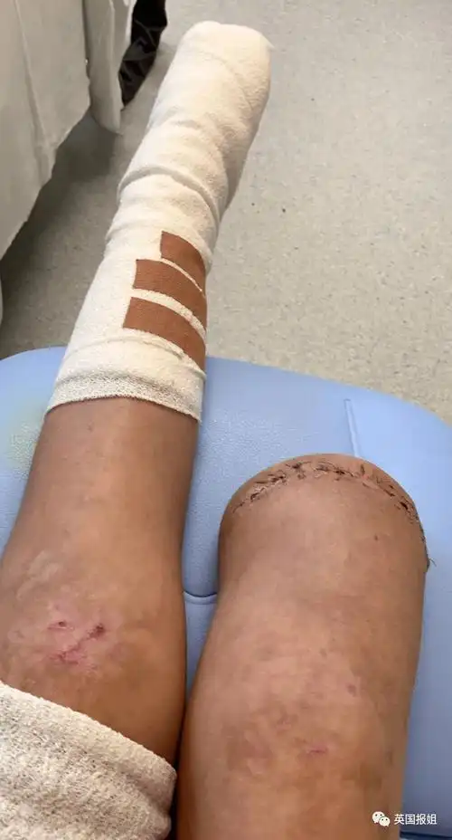 当医生告诉她,她的腿部已经被截肢的时候,她第一反应是不可置信,甚至