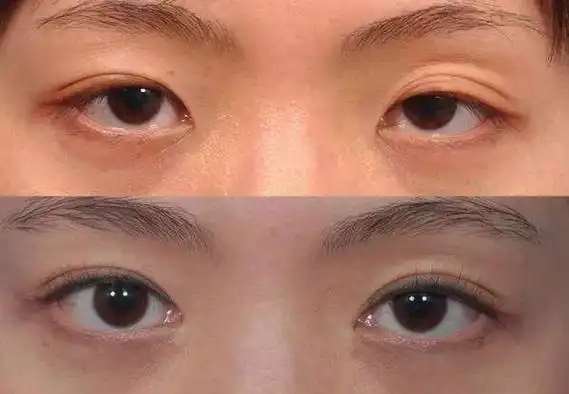 割双眼皮说是肌无力,双眼皮提肌有必要吗?什么叫提肌无力呢?