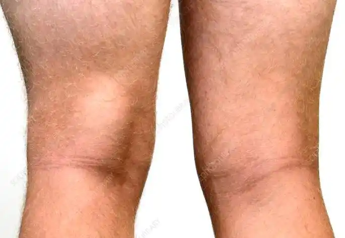 膝盖后面的窝窝鼓包了,可能是腘窝囊肿,到底要紧吗?