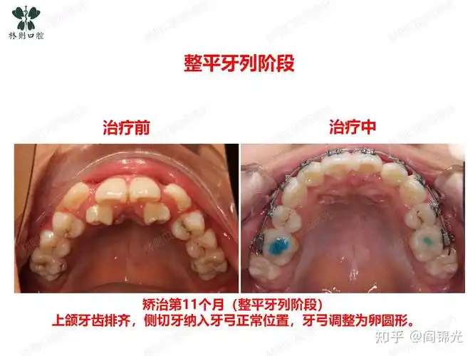 矫正牙齿案例严重牙齿拥挤不齐侧切牙反合