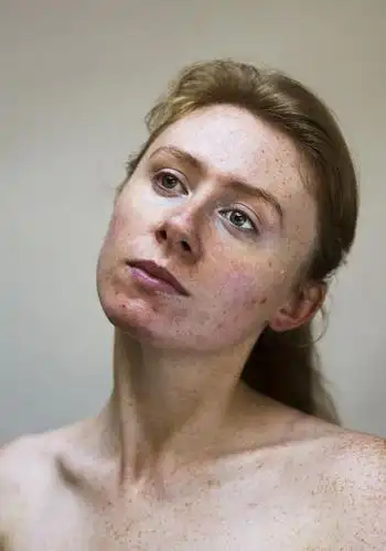 她们满脸吓人的痤疮,红斑,痘痘,却选择勇敢面对素颜