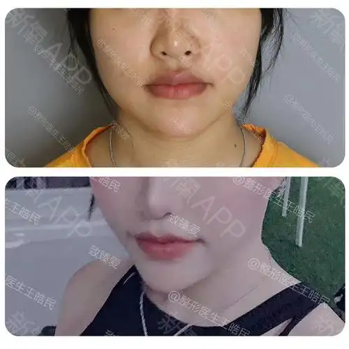 厚唇改薄好不好_效果图_致臻爱小白厚唇改薄术后第3天_新氧美容整形