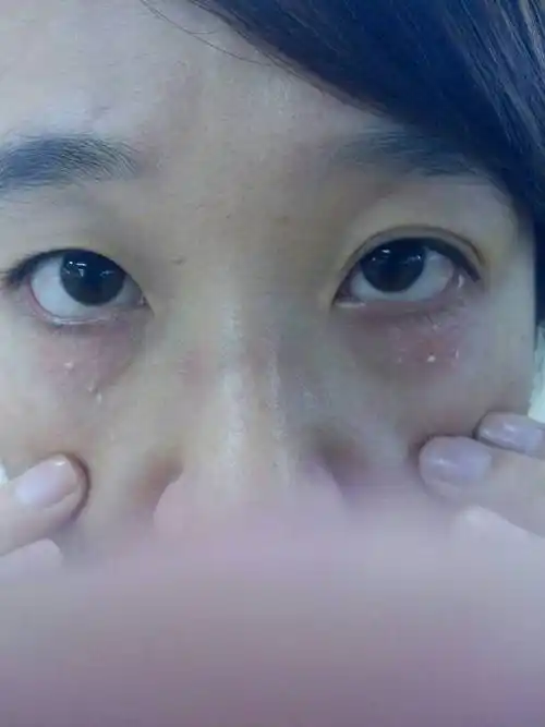 我用无花果的叶子汁涂在下眼皮的脂肪粒上了,谁知方法不当,不应该涂抹