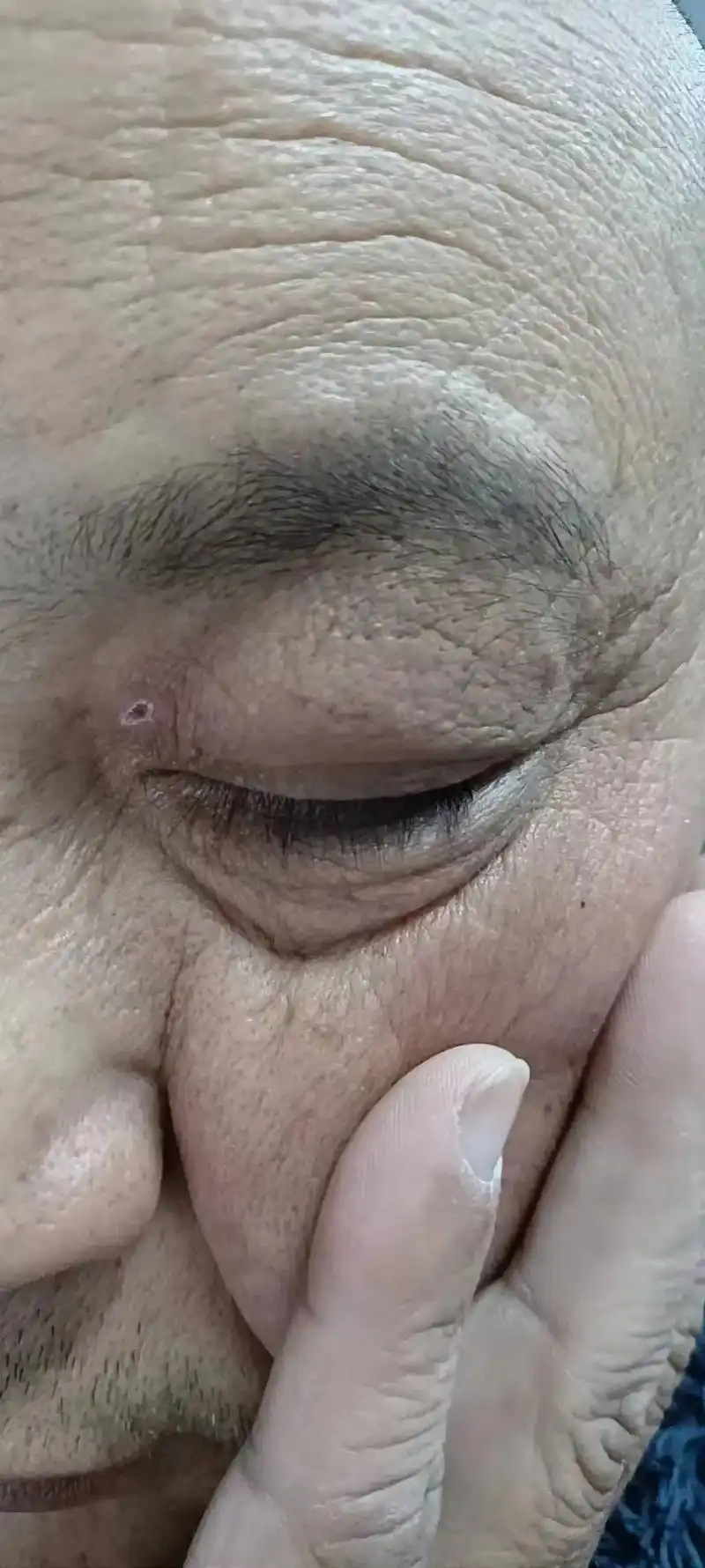 眼黄睑反馈恢复好了做的时候没拍照片有黄豆粒那么大